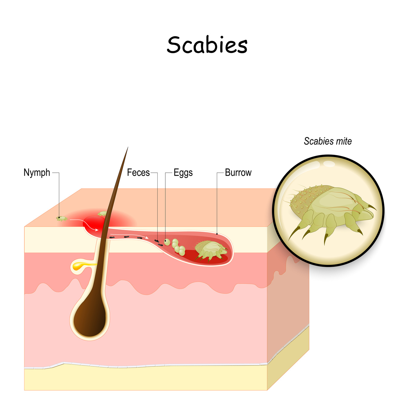 Scabies