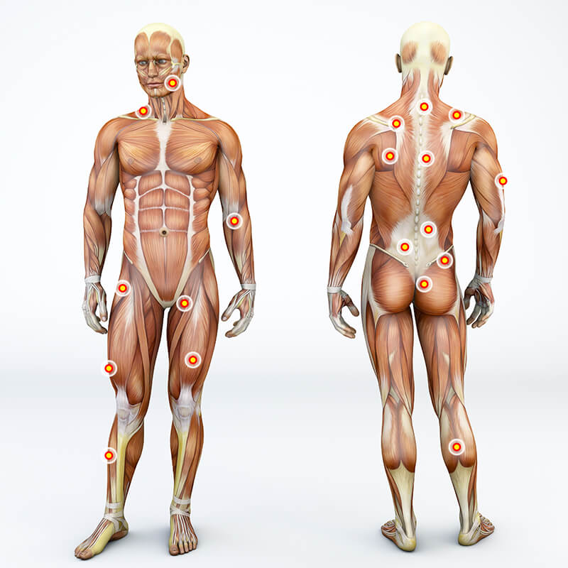 Ganzkörper-Schaubild der Muskeln und Triggerpunkte